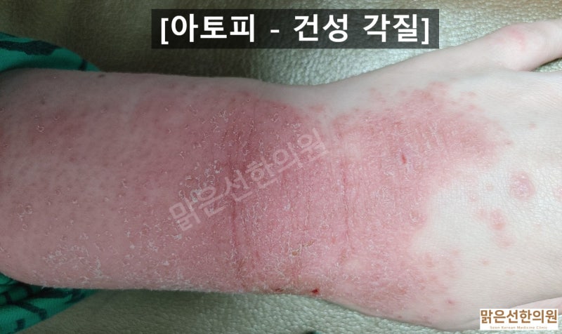 일산피부과의원 염증치료에 집중 3