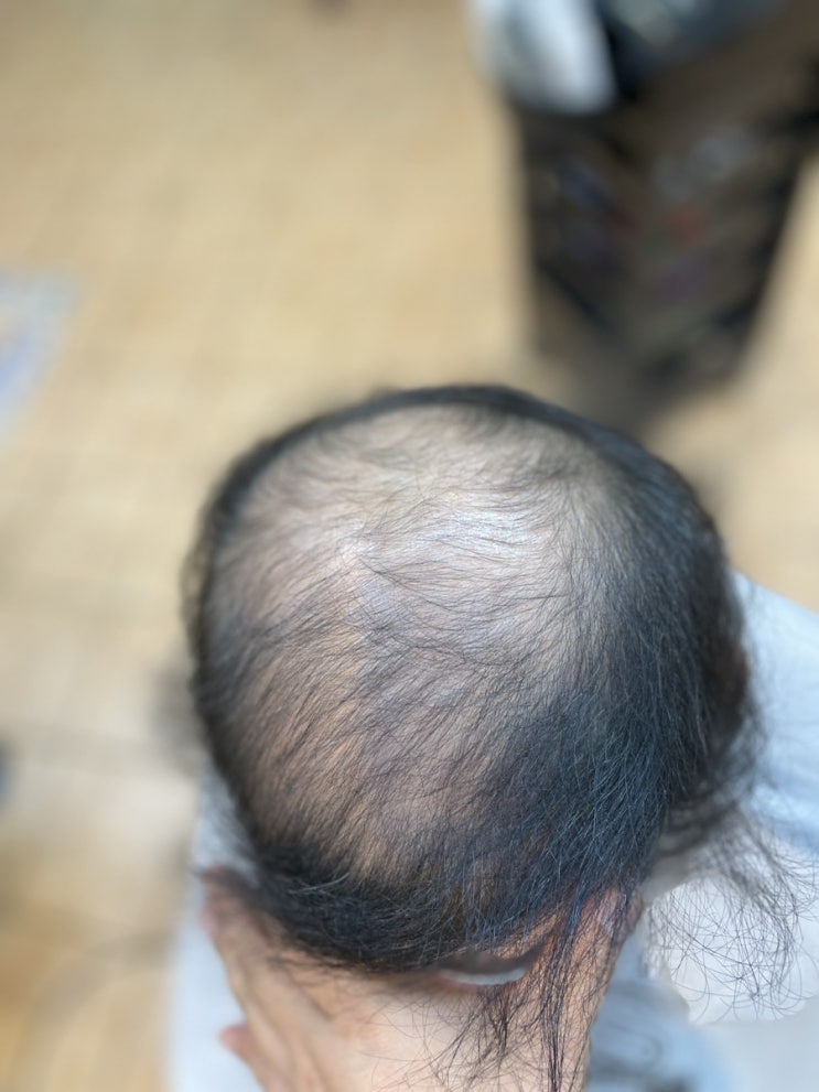  리얼충격 다른곳에서 탈모펌 퇴짜맞은분 탈모성형펌으로 머리에 기초를만들다 부산사상르네시떼미용실 장쌤