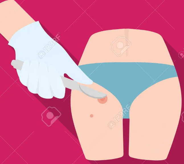  진주항문외과, 드디어 엉덩이 종기 해결하다