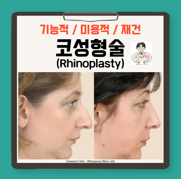  코성형술(Rhinoplasty) (1) - 종류, 이상적인 코, 한국인 코의 특징, 고려할 점, 컴퓨터 시뮬레이션(computer simulation)