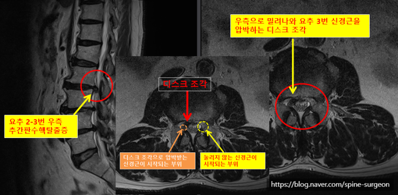 우측 사타구니부터 정강이까지 너무 아파서 못걷겠어요 (요추 2-3번간 우측 추간판수핵탈출증) : 네이버 블로그
