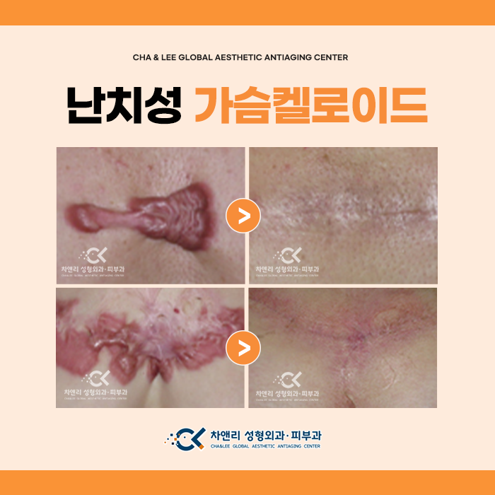  난치성 가슴켈로이드 치료과정