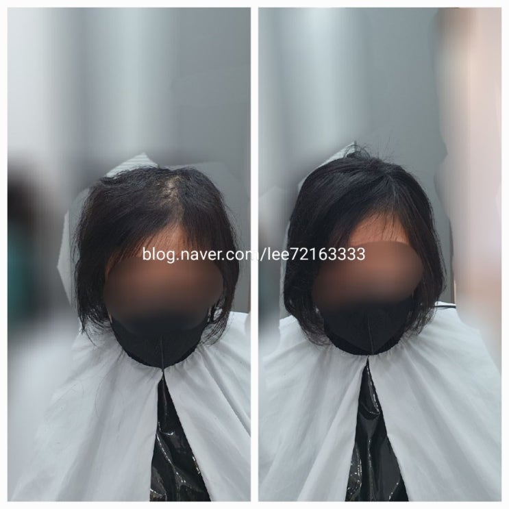  탈모 해결하는 법! 보톡스증모술 여자들이 더 좋아해