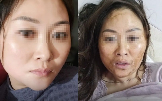 “감염 뒤 혀 검게 변했다”... 중국, 신종변이 공포에 발칵 “감염 뒤 혀 검게 변했다”... 중국, 신종변이 공포에 발칵