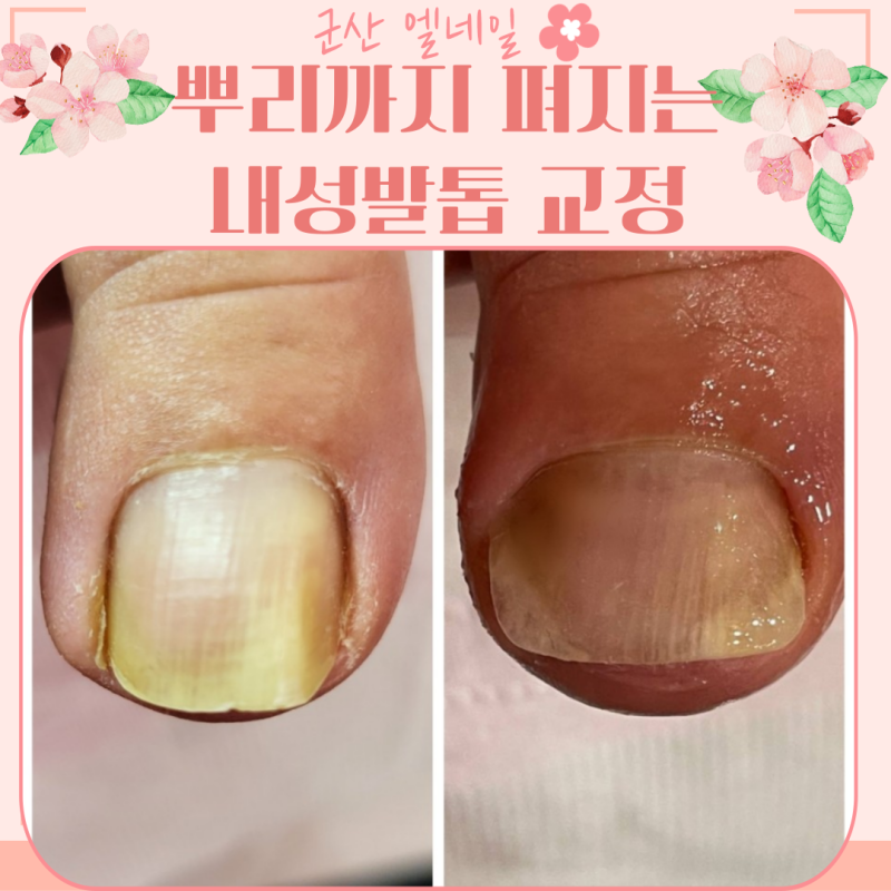 [군산내성발톱] 내성발톱수술 2번에도 고쳐지지 않던 내성발톱~~ 군산내성발톱 교정전문샵 ....