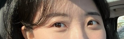 눈밑지방재배치 두번째 후기: 수술 직후부터 2달 경과 기록 눈밑지방재배치 두번째 후기: 수술 직후부터 2달 경과 기록
