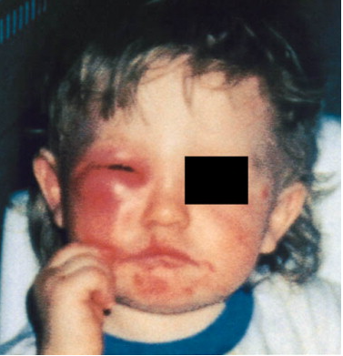 스키터 증후군 (Skeeter syndrome)