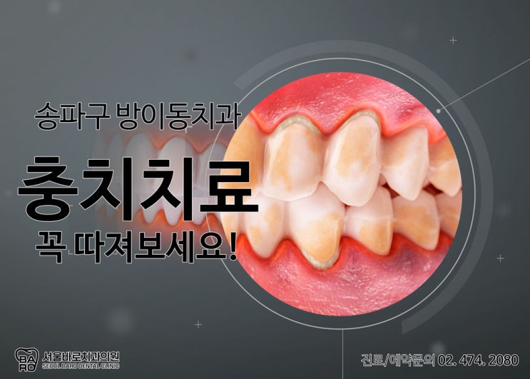  충치치료는 방이동 치과에서 꼭 따져보고 받으세요