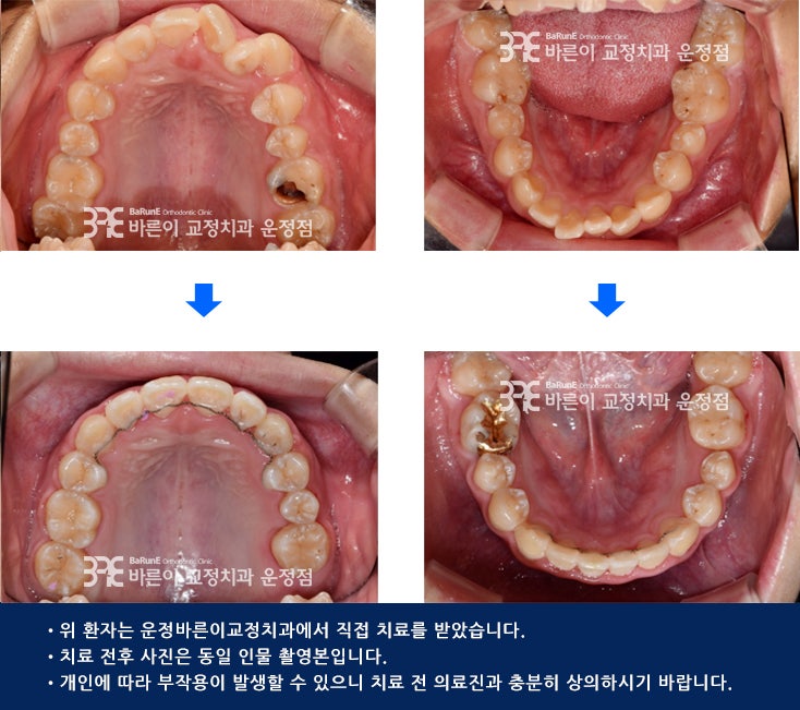 파주치과, 덧니교정 치료사례