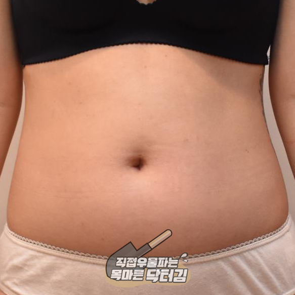  지방파괴주사효과는? 뱃살이 쏙~ 빠졌어요! 바프솔루션