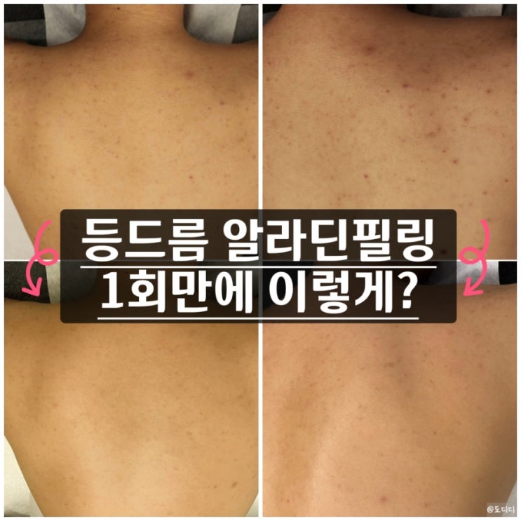  강남 역삼동 등드름 알라딘필링 (로즈드메르 로즈) 흉터, 1회 각질 탈락 과정 후기, 라엘보떼