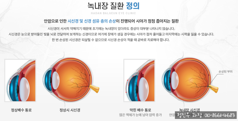 녹내장 수술의 질환과 치료에 대한 설명적 개요