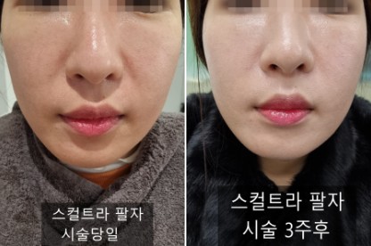  내돈내산 스컬트라팔자후기 3주후효과/청담동피부과/팔자주름 필러대신 스컬트라 통증,부작용,주기,유지기간