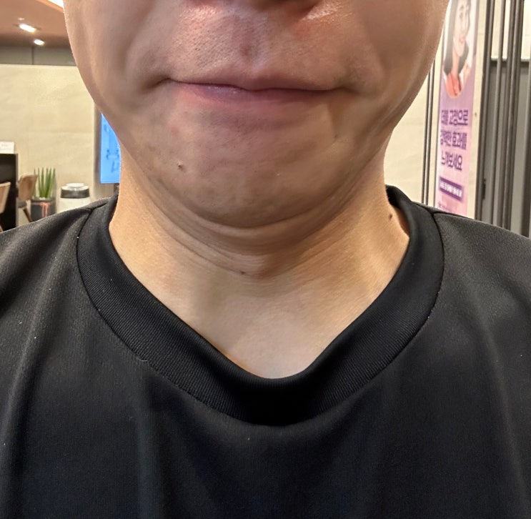  잠실 인모드 fx 효과는? 2주 후 후기까지