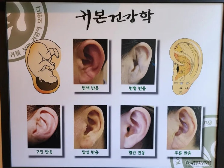  부천 신중동 귀건강 책임지는 이혈요법 이어테라피 라벨르향기