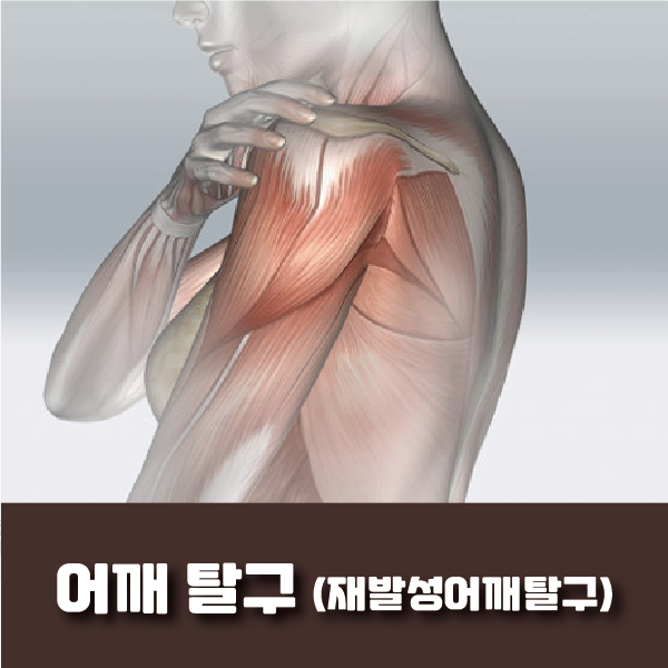 부천정형외과, 어깨 관절 탈구 어깨 빠짐 재발이 쉬운 질환! : 네이버 블로그