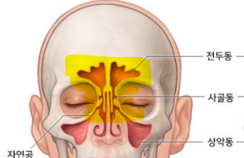 비염, 부비동염 수술 회복 과정 3,4주차