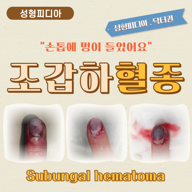  [수부] 조갑하혈종, 손톱멍, 손톱바닥 열상 (feat. 손톱아래에 멍이 들었어요)