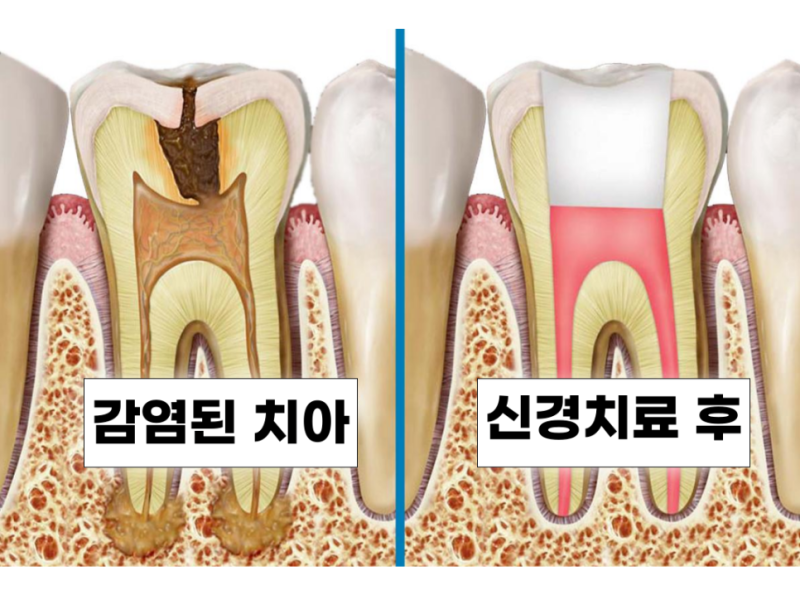 영도치과병원 신경(충치)치료 후 통증, 술자리, 술자리 때문일까요?