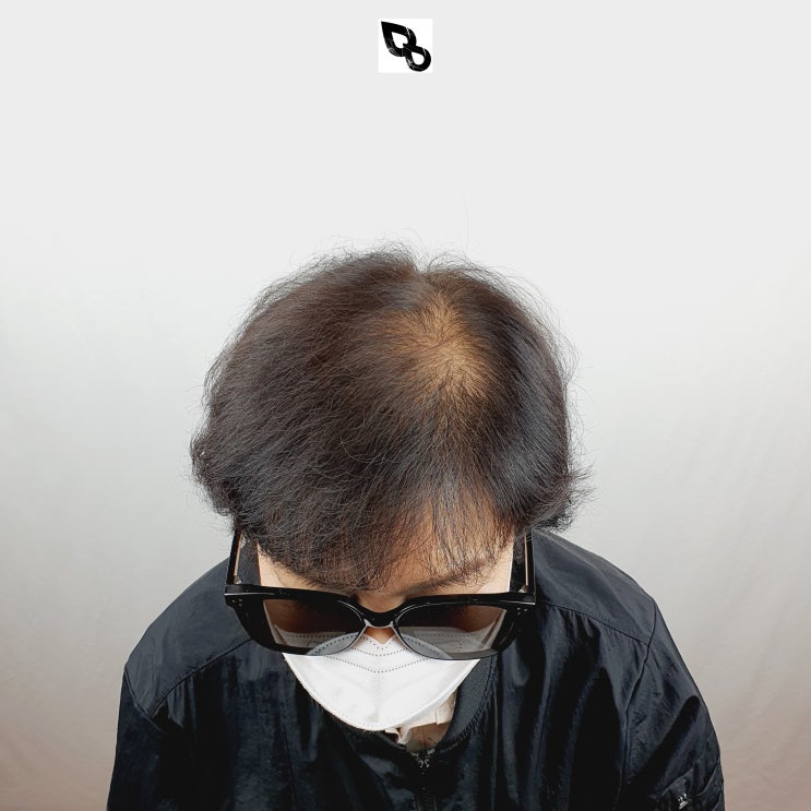  인천두피문신] 정수리 탈모 SMP하세요