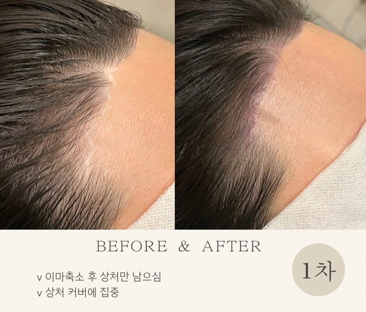  아인뷰티랩 건대점에서 두피문신 헤어라인문신 눈썹문신 흉터 커버!
