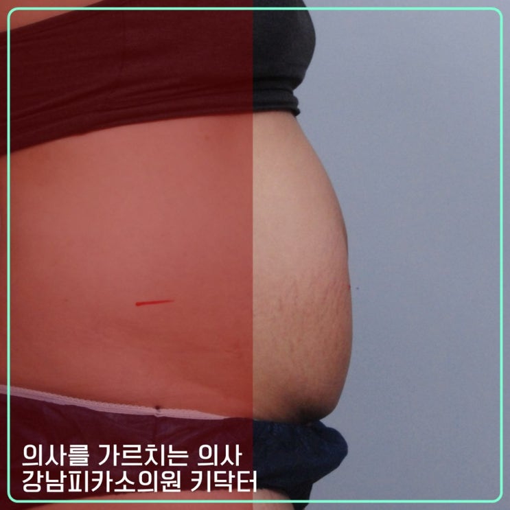  바디리프팅&지방제거 사이저 가격, 복부비만시술 효과 좋은것은?