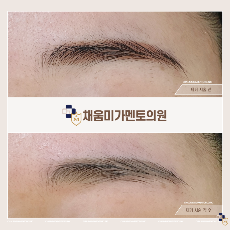 눈썹문신 후 바로 제거 가능한가요? 4