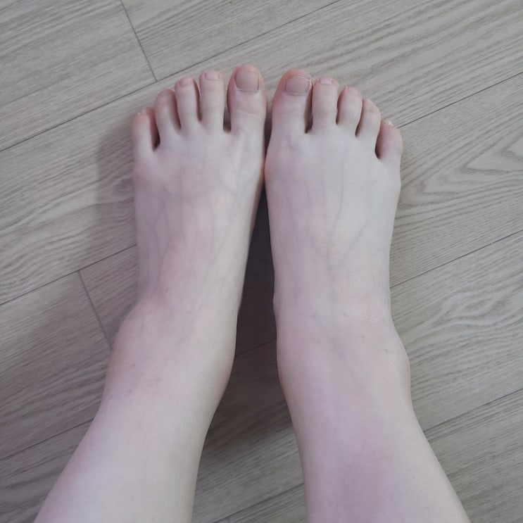  일란성쌍둥이 28주 입체초음파, 다리 부종 압박스타킹 처방