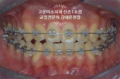  좋은 교정치과찾는 법 3급부정교합 앞니 반대교합 주걱턱 비수술교정 비발치교정 재교정 신촌교정치과 고운미소신촌1호점 치료증례