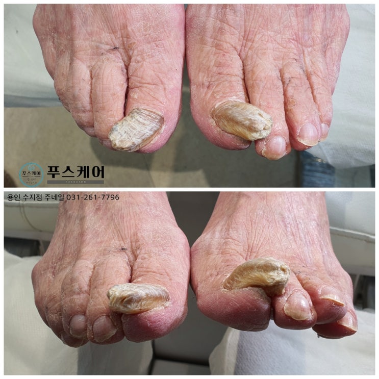 90세 할머니 역대급 두꺼운발톱 변형된발톱으로 아드님이 모시고 오셨어요./성남수원수지보정동백죽전동/주네일푸스케어용인수지점/파고드는무좀내성발톱변형전문점 90세 할머니 역대급 두꺼운발톱 변형된발톱으로 아드님이 모시고 오셨어요./성남수원수지보정동백죽전동/주네일푸스케어용인수지점/파고드는무좀내성발톱변형전문점
