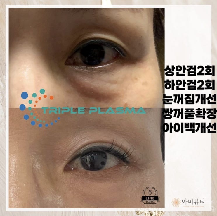  눈밑꺼짐 다크써클 눈가주름 모두 콜드플라즈마  해결해드립니다 (대구아미뷰티 )