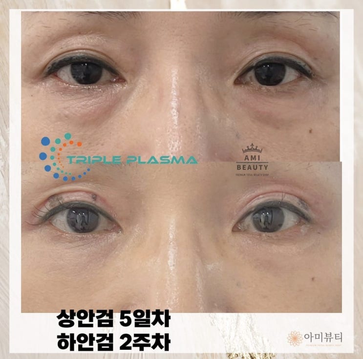  상안검 리프팅 고민되시면 플라스마블라스트 대구 아미뷰티에서 받으세요