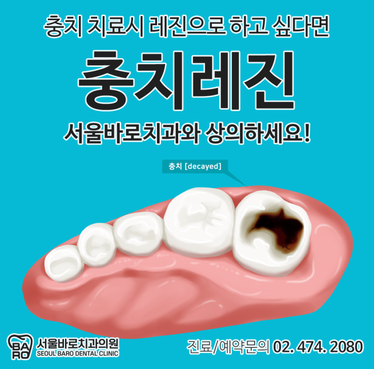  충치치료 시 레진을 사용하면 좋은 점을 성내동 치과에서 알려드리자면