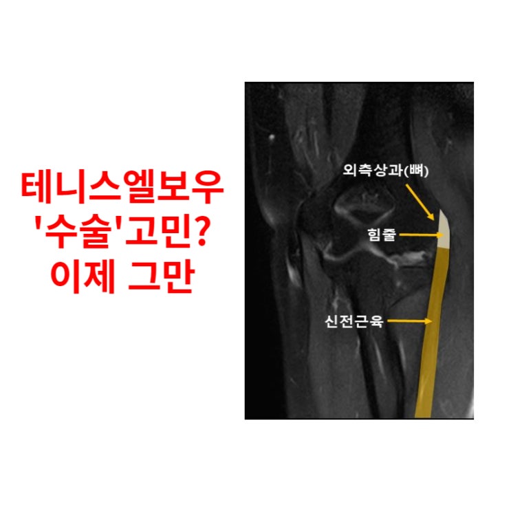  테니스엘보우치료, '비수술' 방법이 있습니다