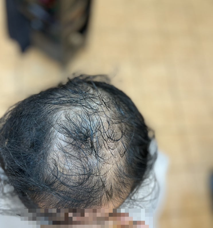  강서구명지동에서왔어요 모발이식 복합탈모 남성탈모펌으로 끝장내기 [부산사상르네시떼미용실]부산미용사상미용감전미용괘법미용덕천미용화명미용서면미용주례미용동래미용사직미용금정미용김해미용경남미용