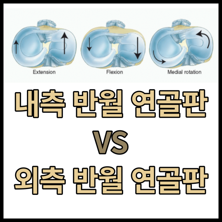  내,외측 반월 연골판 해부학적 특징 및 차이점 / 반월대퇴인대meniscofemeral ligament, Humphry ligament, Wrisberg ligament