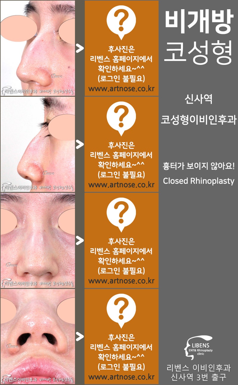 강남 신사역 코성형이비인후과에서 후회 없는 수술 받기