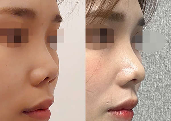 비중격연장, 코끝만 높여도 콧대도 높아지나요???