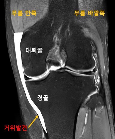  거위발건염 치료, 무릎 내측 통증 내버려 두지 마세요