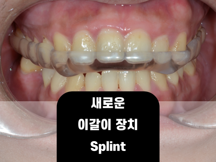 편안하고 특이한 이갈이 스플린트 장치, 변색과 알레르기 반응 없는 장치를 소개합니다. 편안하고 특이한 이갈이 스플린트 장치, 변색과 알레르기 반응 없는 장치를 소개합니다.