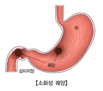  십이지장 궤양의 증상과 원인 정보