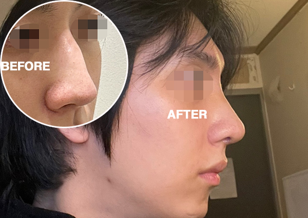  남자코성형, 콤플렉스였던 매부리코교정!(강남 치유성형외과)