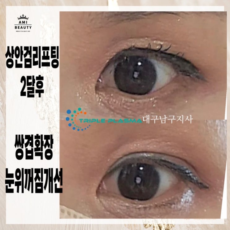  플라즈마블라스트 처진 쌍꺼풀 교정 상안검 리프팅 하세요  (대구 아미뷰티)