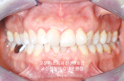  윗니불규칙 앞니돌출 2급부정교합치료 40대교정치료 비발치치료증례 신촌 교정전문의  강대운원장 고운미소신촌1호점 치료증례