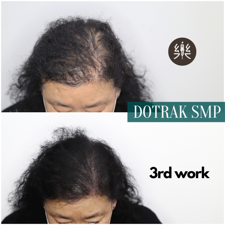  smp 가르마 탈모로 머리 빠진다면