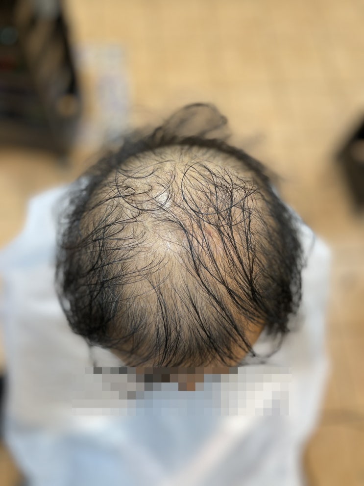  부산중구남포동에서 왔어요 심한남자탈모 헤어 나올수없는 탈모펌매력/ 사상덕천화명하단당감명지김해거제영도서면전포부전양정동래수영망미용원남천장전금곡초량범천반송해운대광안리연제양정경남경북남해