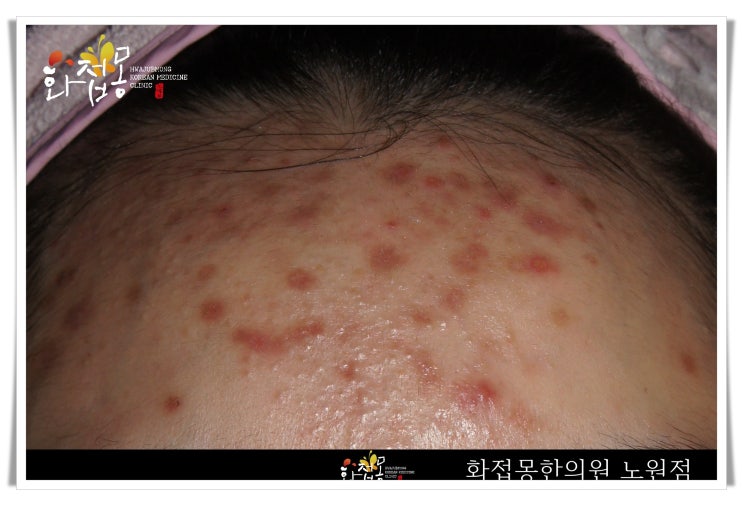  노원여드름자국 화안케어로 말끔히 지워지네요^^