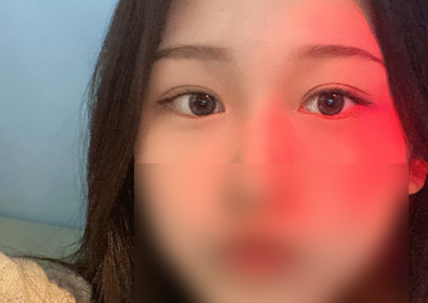  쌍꺼풀수술(뒤트임+눈위지방제거)치유성형외과 한진우원장님,눈성형