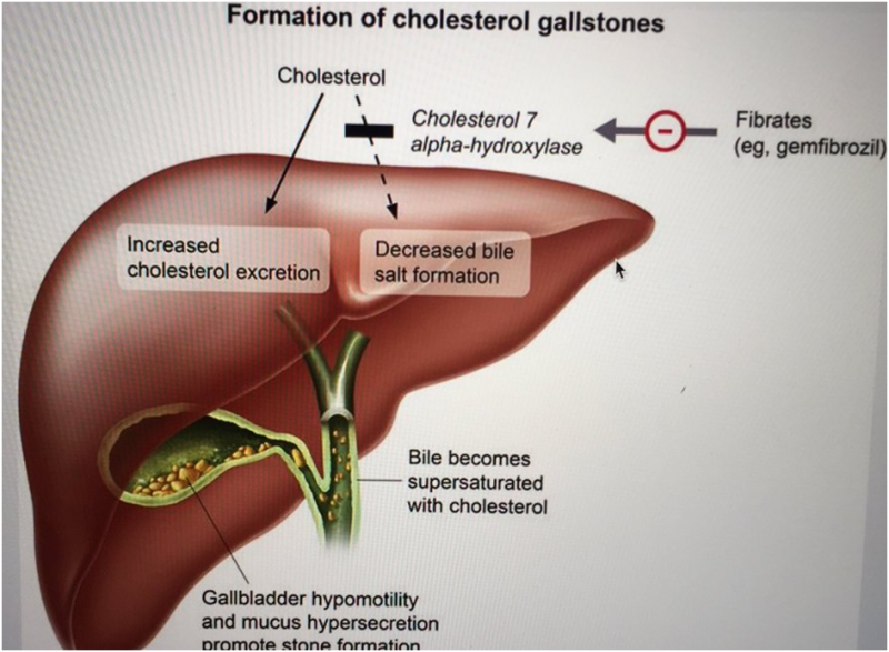 담석 (Gallstone) 생성을 막는 방법과 물질 : 네이버 블로그