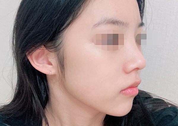 들창코수술 후, 여성스러워진 이미지(강남성형외과 치유)